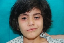 Doğuştan Yüz Felci Neden Olur?