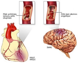 Felç Çeşitleri Türleri ve Özellikleri